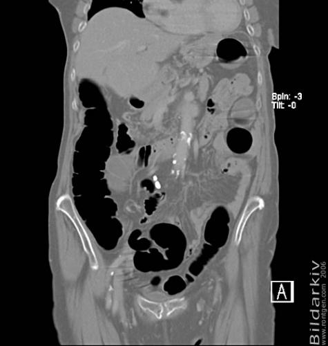 CT colon 23